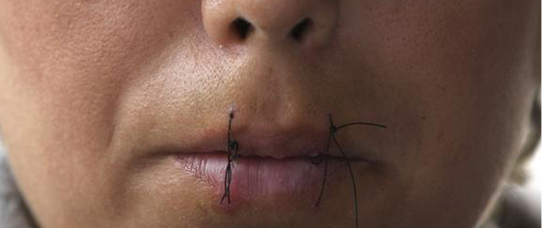 Sewed lips of an Iranian refugee in protest of rejection of her asylum request